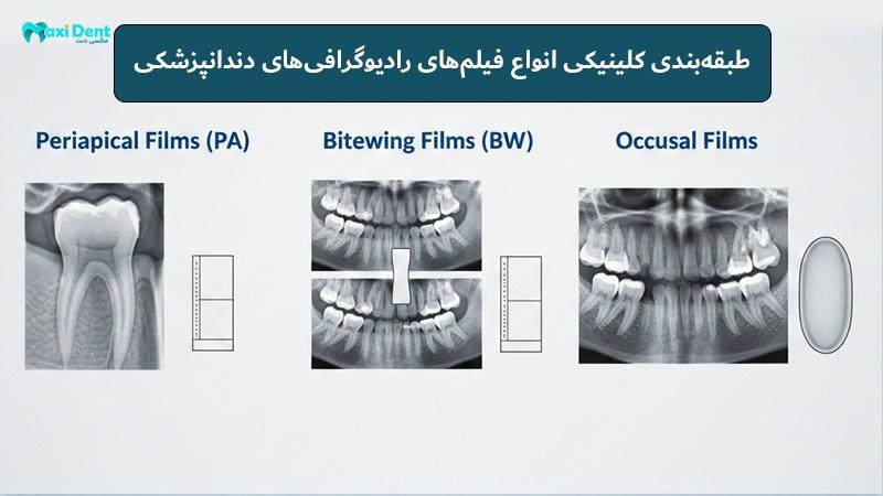 انواع فیلم های رادیوگرافی دندان پزشکی