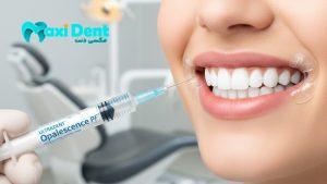 نحوه استفاده از بلیچینگ اولترادنت